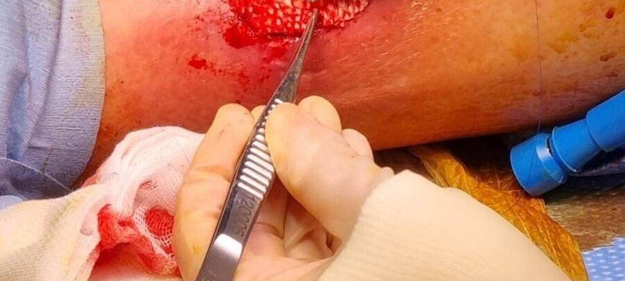 Fischhaut zur Behandlung von großen Wunden